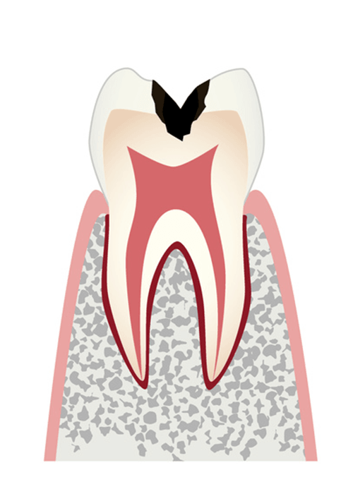 歯の内部まで進行した虫歯（象牙質の虫歯）